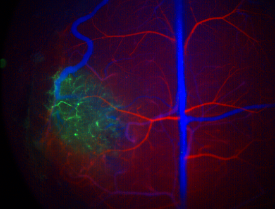 SWIR imaging of a glioma labelled with quantum dots (green). Arteries (red) and veins (blue) labelled with intravasculare contrast agent.